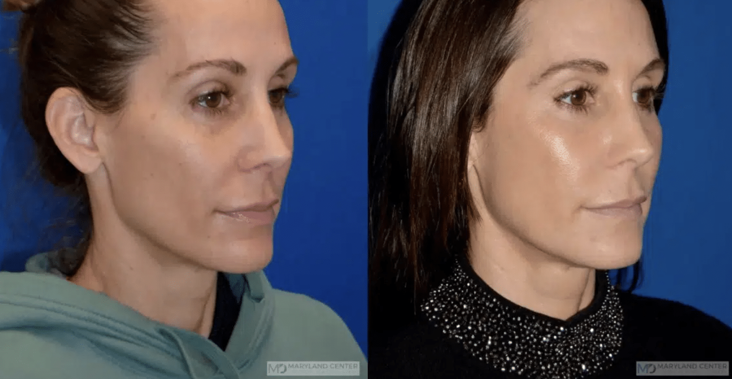 Sculptra in Baltimore, MD.